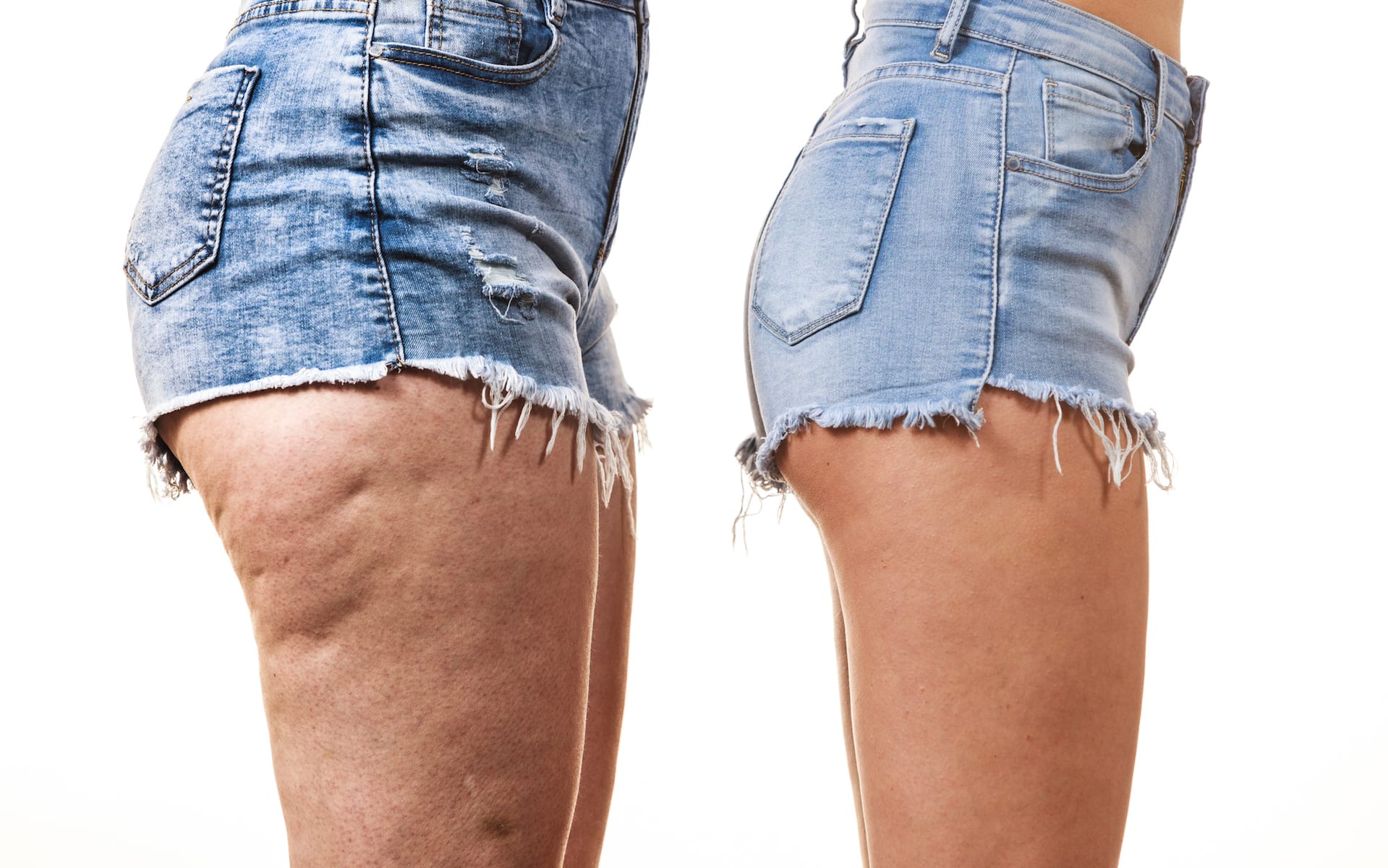 Addressing Excess Skin With A Lower Body Lift Elements Toronto Addressing Excess Skin With A Lower Body Lift Elements Toronto