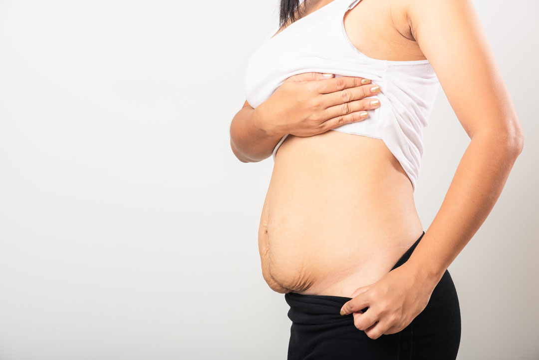 Addressing a Belly Bulge After Pregnancy